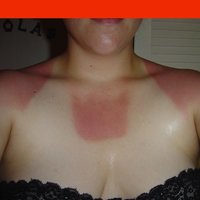 Sonnenbrand2.jpg