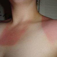 sonnenbrand3.jpg