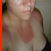 sonnenbrand.jpg