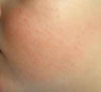 Thara Ausschlag1.jpg