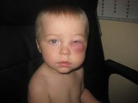 dickes auge.JPG