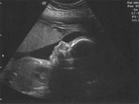 Ultraschall-04.06..jpg